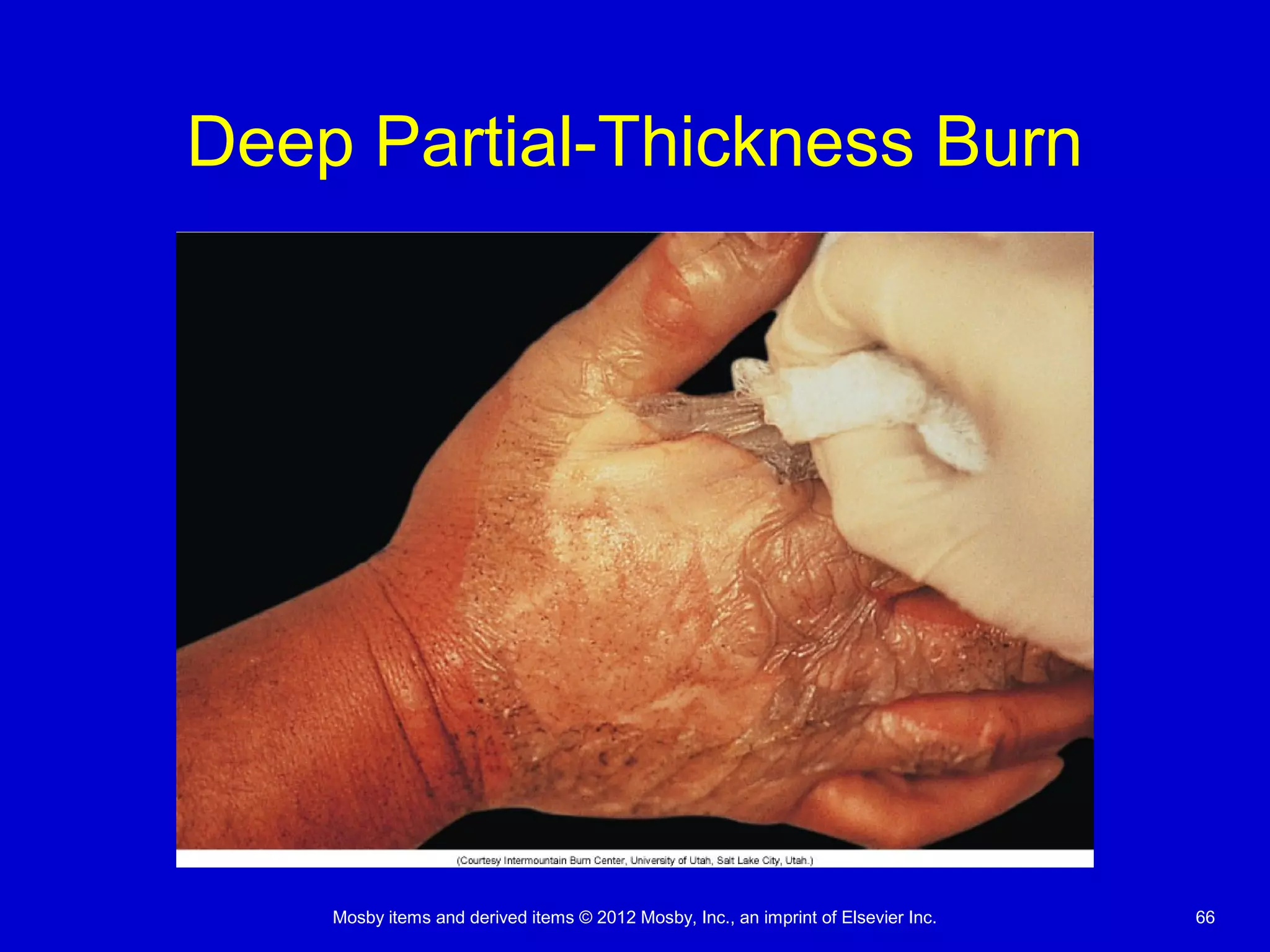 Mosby items and derived items © 2012 Mosby, Inc., an imprint of Elsevier Inc. 66
Deep Partial-Thickness Burn
 