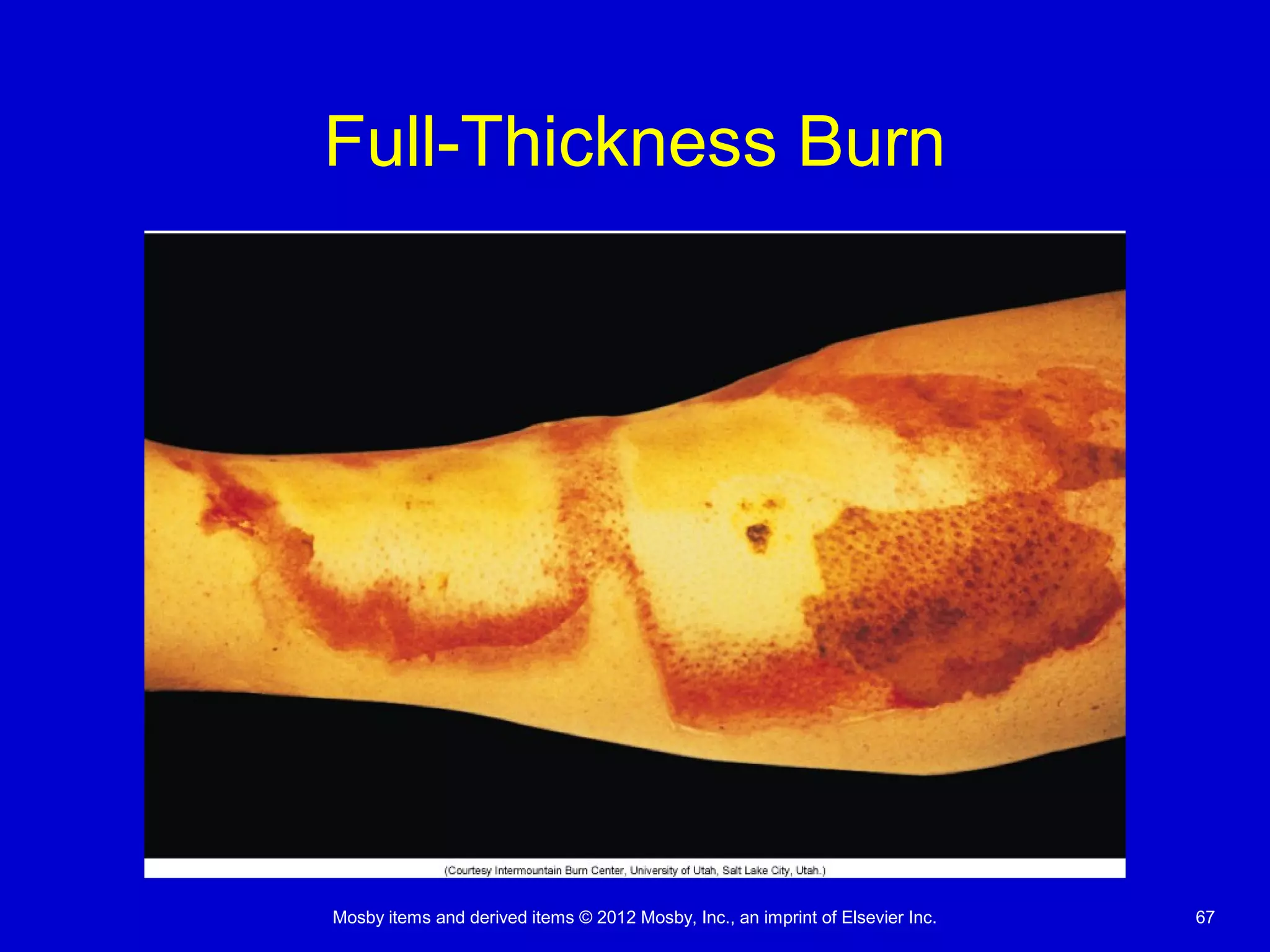 Mosby items and derived items © 2012 Mosby, Inc., an imprint of Elsevier Inc. 67
Full-Thickness Burn
 