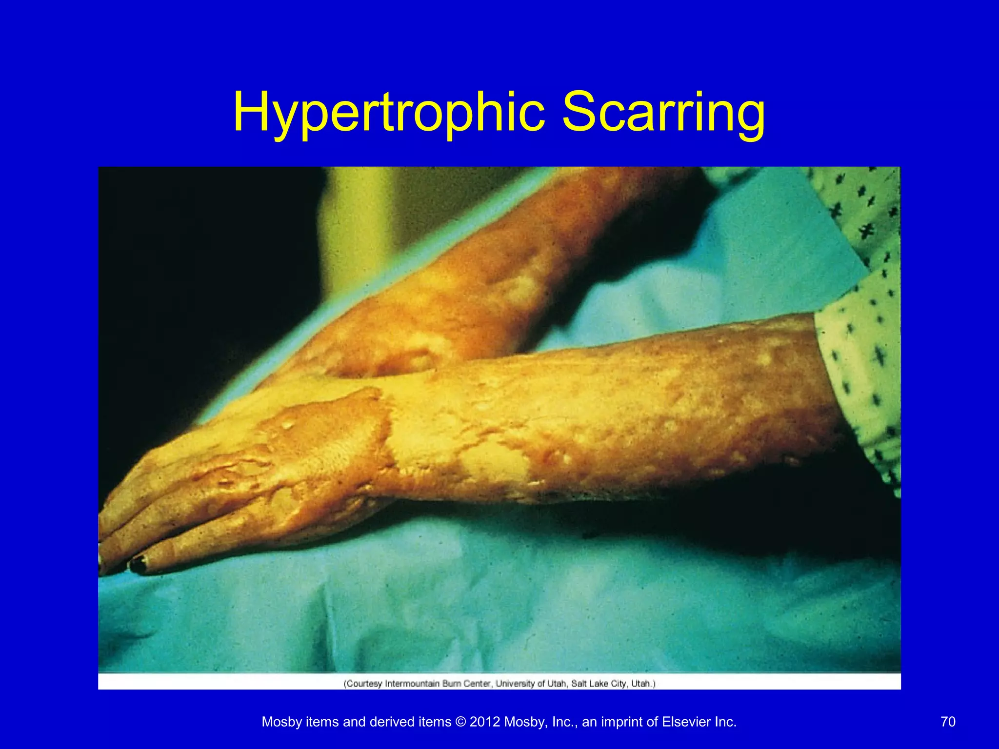 Mosby items and derived items © 2012 Mosby, Inc., an imprint of Elsevier Inc. 70
Hypertrophic Scarring
 