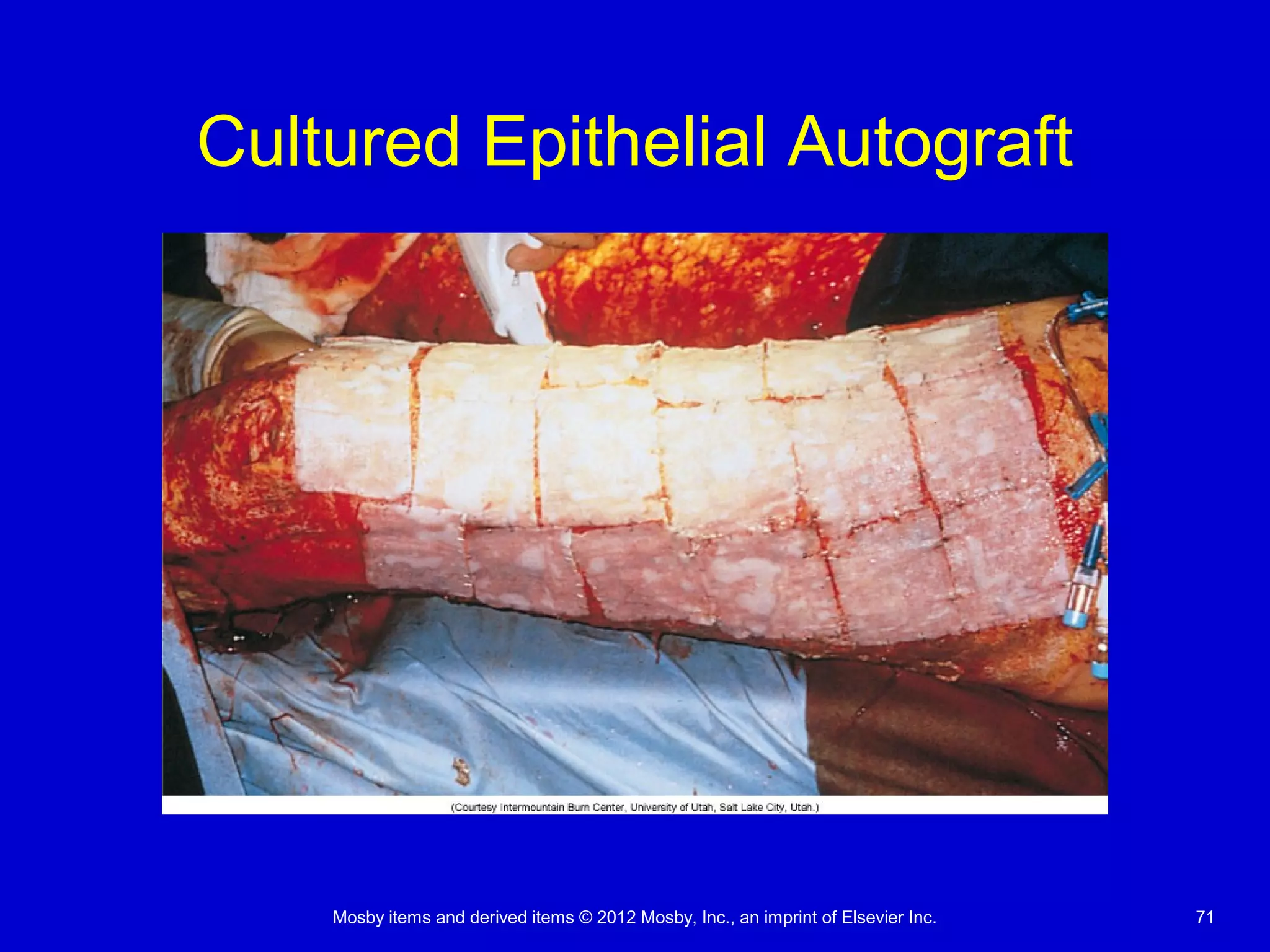 Mosby items and derived items © 2012 Mosby, Inc., an imprint of Elsevier Inc. 71
Cultured Epithelial Autograft
 