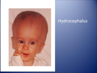Hydrocephalus
 