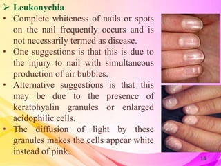  Leukonychia
• Complete whiteness of nails or spots
on the nail frequently occurs and is
not necessarily termed as diseas...