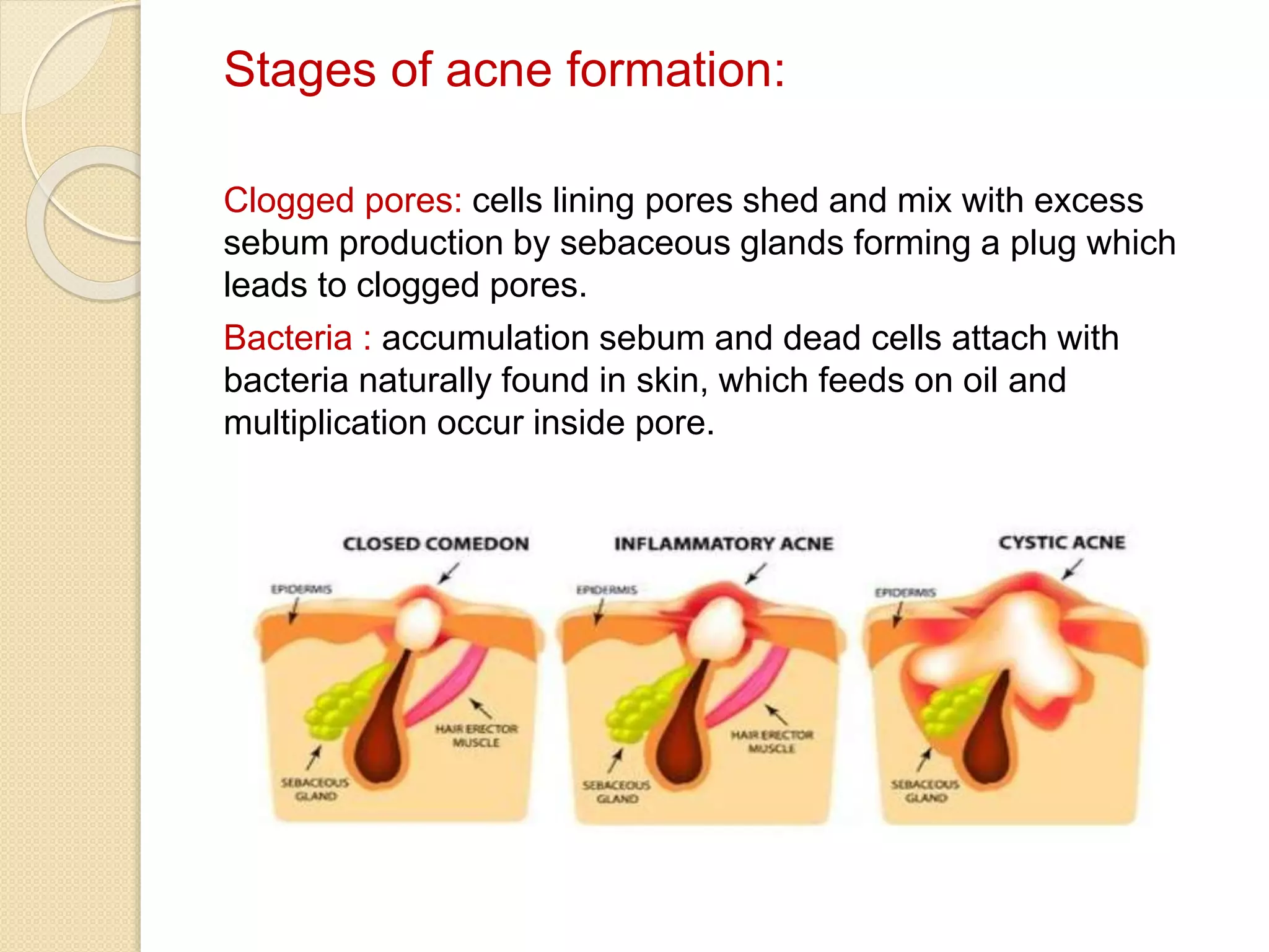 Stages of acne formation:
Clogged pores: cells lining pores shed and mix with excess
sebum production by sebaceous glands forming a plug which
leads to clogged pores.
Bacteria : accumulation sebum and dead cells attach with
bacteria naturally found in skin, which feeds on oil and
multiplication occur inside pore.
Inflammation : This bacterial overgrowth triggers the natural
inflammatory response which leads to redness and swelling.
 