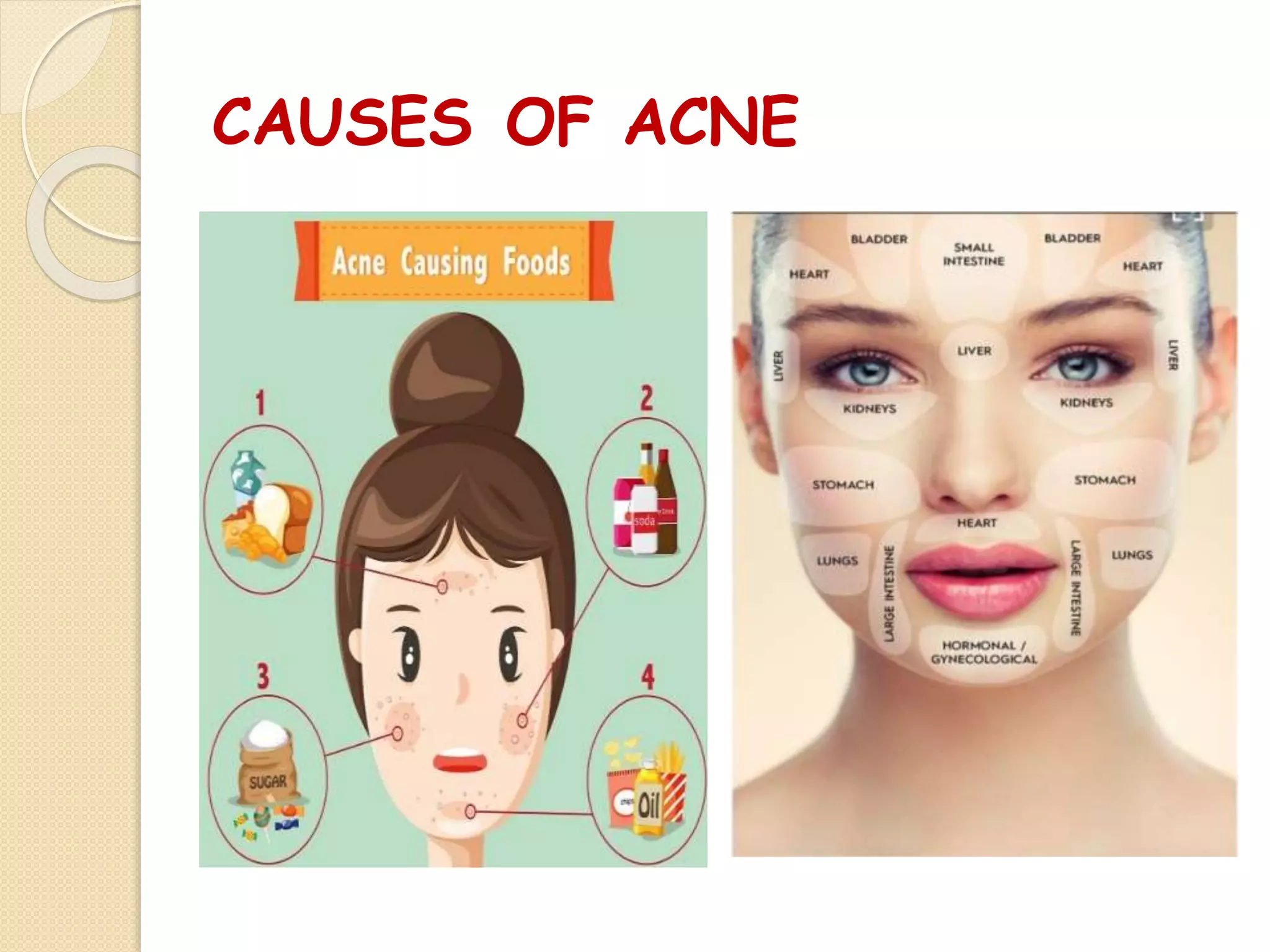 CAUSES OF ACNE
 