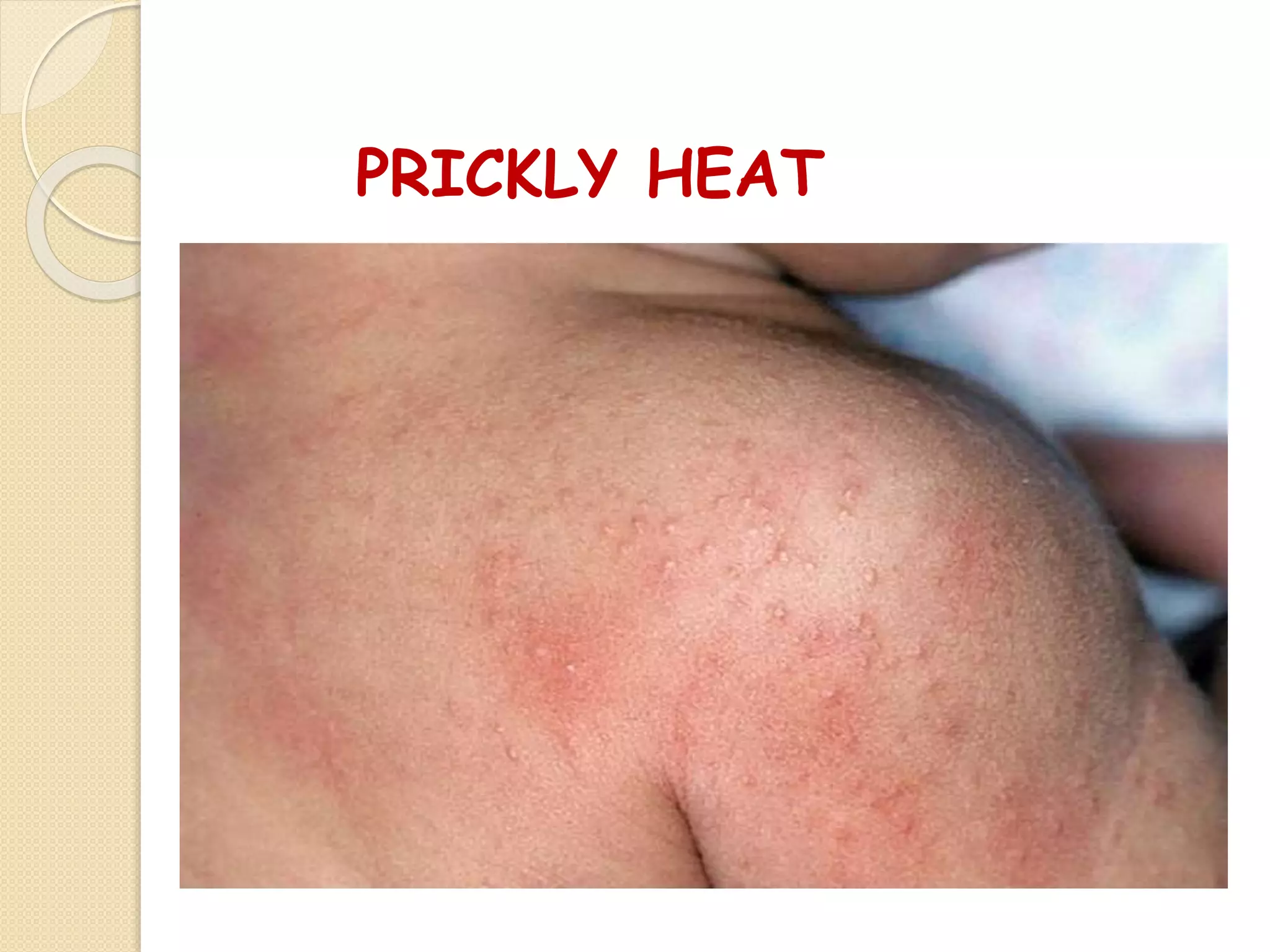 PRICKLY HEAT
 