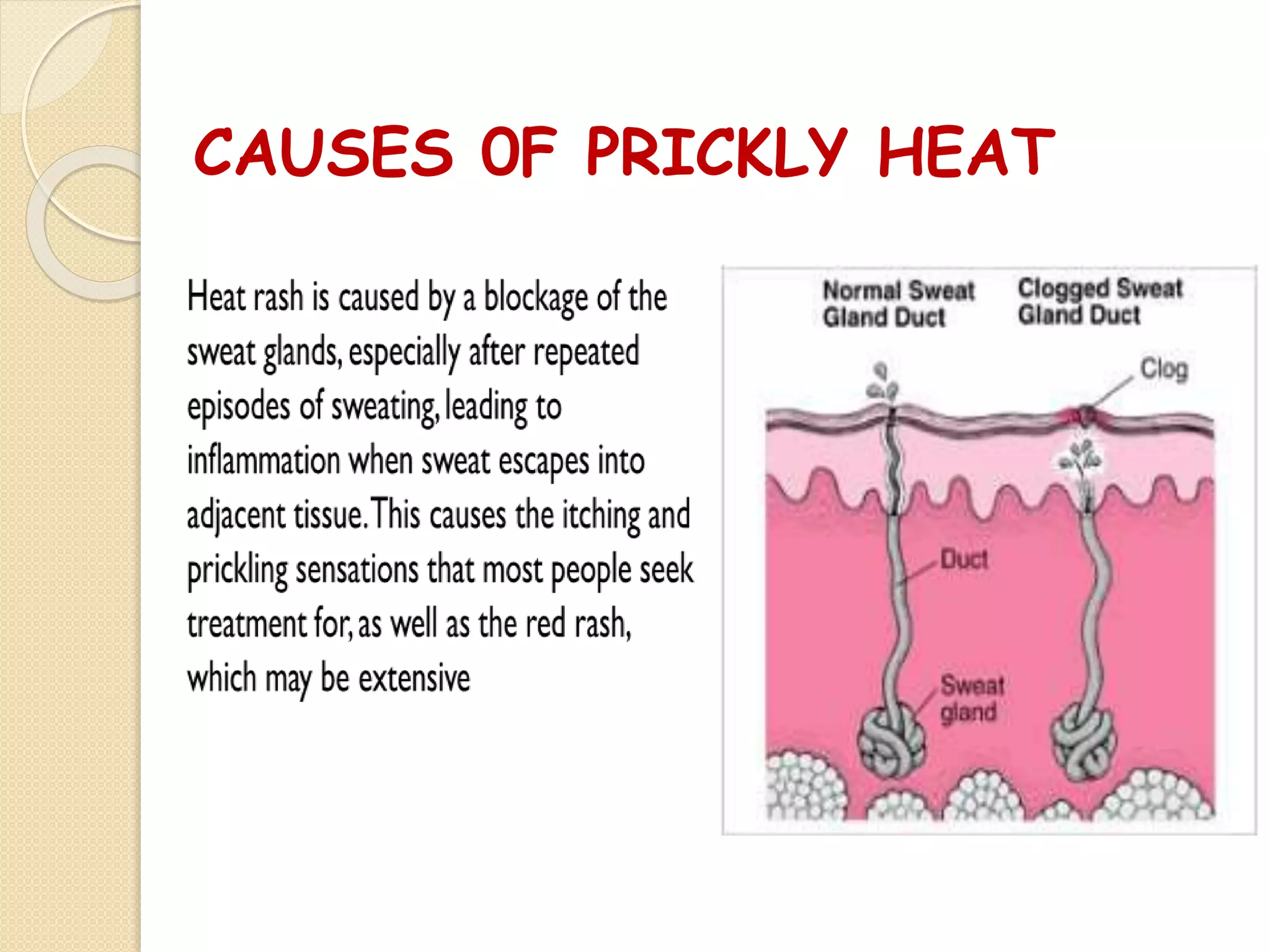 CAUSES 0F PRICKLY HEAT
 