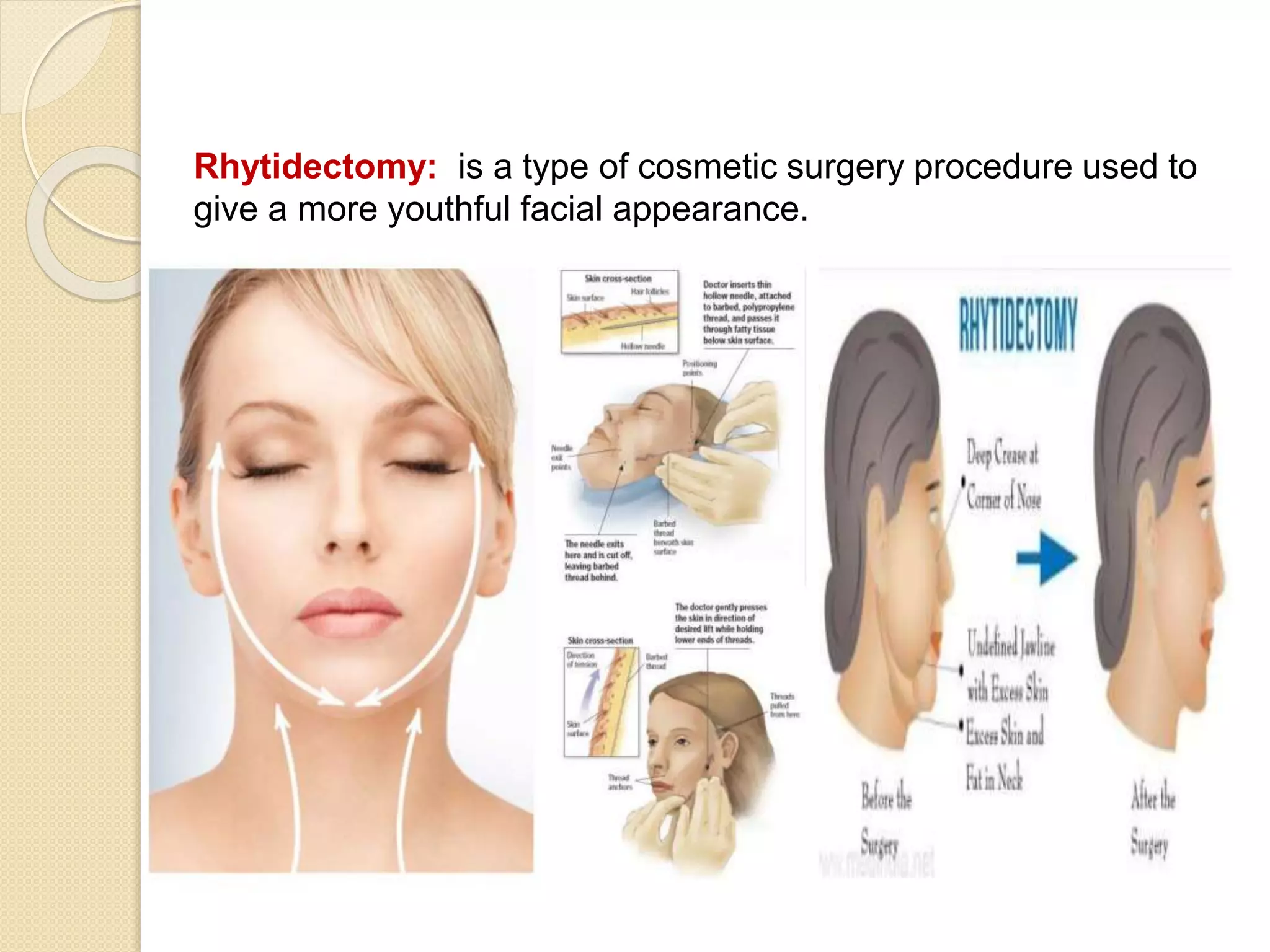 Rhytidectomy: is a type of cosmetic surgery procedure used to
give a more youthful facial appearance.
 