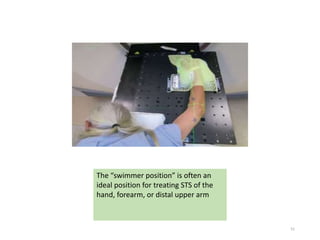 51
The “swimmer position” is often an
ideal position for treating STS of the
hand, forearm, or distal upper arm
 