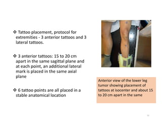  Tattoo placement, protocol for
extremities - 3 anterior tattoos and 3
lateral tattoos.
 3 anterior tattoos: 15 to 20 cm
apart in the same sagittal plane and
at each point, an additional lateral
mark is placed in the same axial
plane
 6 tattoo points are all placed in a
stable anatomical location
52
Anterior view of the lower leg
tumor showing placement of
tattoos at isocenter and about 15
to 20 cm apart in the same
 