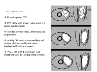 59
POST OP RT CTV
 Phase I – preop GTV
 CTV = GTV with 1.5 cm radial and 4 cm
cranio-caudal margin
 includes all visible clips, drain sites and
surgical scar
 radially CTV need not expand beyond
surface of bones and fascia, unless
involved with tumor at surgery
 PTV = CTV with 1 cm margin in all
directions (vary by institutional protocols)
 
