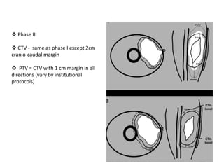 60
 Phase II
 CTV - same as phase I except 2cm
cranio-caudal margin
 PTV = CTV with 1 cm margin in all
directions (vary by institutional
protocols)
 