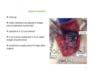 BRACHYTHERAPY
 intra op
 nylon catheters are placed in target
area of operative tumor bed
 spaced at 1-1.5 cm interval
 2 cm cranio-caudal and 1-2 cm radial
margin around tumor
 treatment usually starts 4-5 days after
surgery
68
 