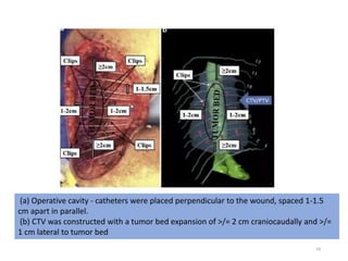 69
(a) Operative cavity - catheters were placed perpendicular to the wound, spaced 1-1.5
cm apart in parallel.
(b) CTV was constructed with a tumor bed expansion of >/= 2 cm craniocaudally and >/=
1 cm lateral to tumor bed
 
