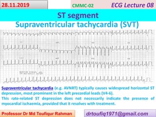 Svt Depression ECG- ST segment | PPSX