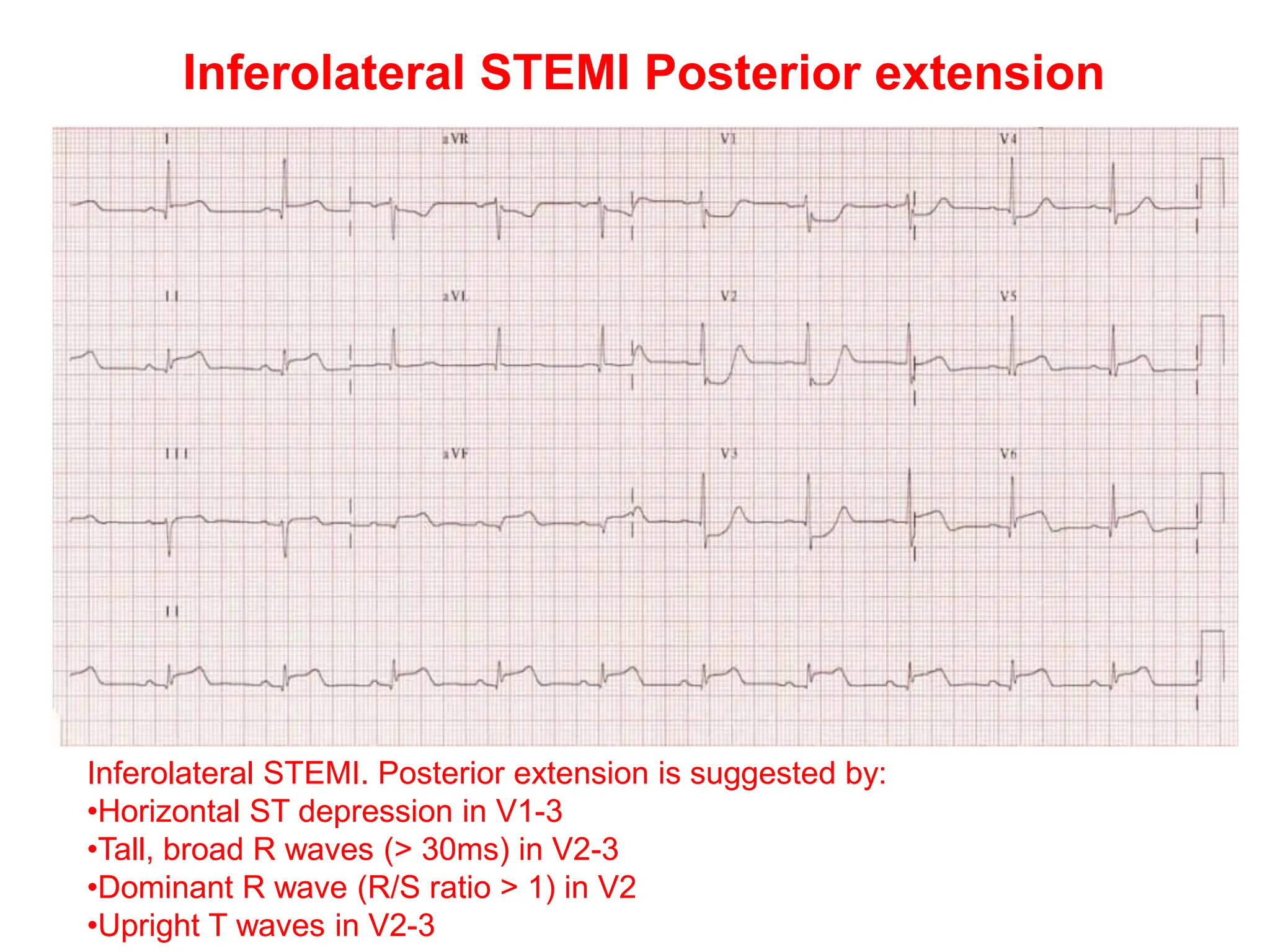 ST SEGMENT IN ECG,ST ELEVATION AND ST DEPRESSION | PPTX