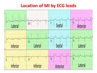 Location of MI by ECG leads
 