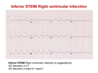 Inferior STEMI Right ventricular infarction
Inferior STEMI Right ventricular infarction is suggested by:
•ST elevation in V1
•ST elevation in lead III > lead II
 