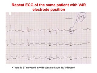 Repeat ECG of the same patient with V4R
electrode position
•There is ST elevation in V4R consistent with RV infarction
 