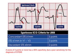 A score of 3 points or more has a 90% specificity (but a poor sensitivity) for the
diagnosis of STEMI
 