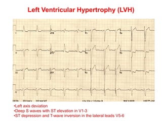 Left Ventricular Hypertrophy (LVH)
•Left axis deviation
•Deep S waves with ST elevation in V1-3
•ST depression and T-wave inversion in the lateral leads V5-6
 