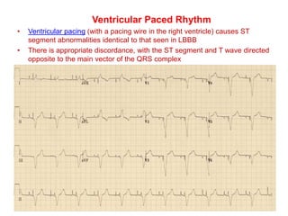 Ventricular Paced Rhythm
• Ventricular pacing (with a pacing wire in the right ventricle) causes ST
segment abnormalities identical to that seen in LBBB
• There is appropriate discordance, with the ST segment and T wave directed
opposite to the main vector of the QRS complex
 