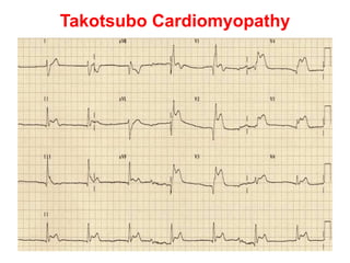 Takotsubo Cardiomyopathy
 