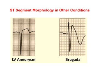 ST Segment Morphology in Other Conditions
 