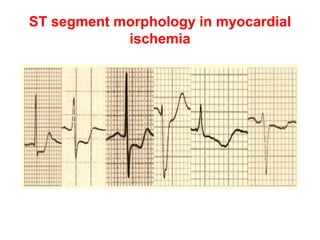 ST segment morphology in myocardial
ischemia
 