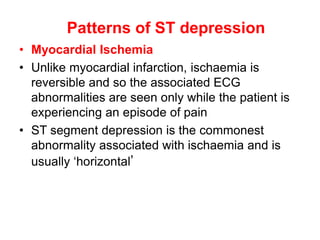 Patterns of ST depression
• Myocardial Ischemia
• Unlike myocardial infarction, ischaemia is
reversible and so the associated ECG
abnormalities are seen only while the patient is
experiencing an episode of pain
• ST segment depression is the commonest
abnormality associated with ischaemia and is
usually ‘horizontal’
 