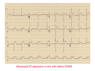 •Reciprocal ST depression in aVL with inferior STEMI
 