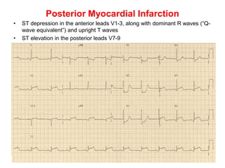 Posterior Myocardial Infarction
• ST depression in the anterior leads V1-3, along with dominant R waves (“Q-
wave equivalent”) and upright T waves
• ST elevation in the posterior leads V7-9
 
