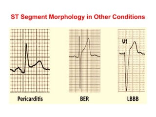 ST Segment Morphology in Other Conditions
 