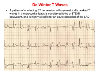De Winter T Waves
• A pattern of up-sloping ST depression with symmetrically peaked T
waves in the precordial leads is considered to be a STEMI
equivalent, and is highly specific for an acute occlusion of the LAD
 