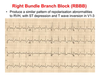 Right Bundle Branch Block (RBBB)
• Produce a similar pattern of repolarisation abnormalities
to RVH, with ST depression and T wave inversion in V1-3
 