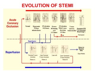 EVOLUTION OF STEMI
 
