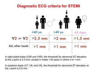 Diagnostic ECG criteria for STEMI
In right-sided leads (V3R and V4R), the threshold for abnormal ST elevation
at the J point is 0.5 mm, except in males <30 years in whom it is 1 mm
In posterior leads (V7, V8, and V9), the threshold for abnormal ST elevation at
the J point is 0.5 mm
 