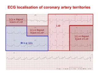 ECG localisation of coronary artery territories
 