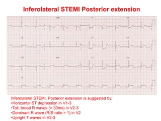 Inferolateral STEMI Posterior extension
Inferolateral STEMI. Posterior extension is suggested by:
•Horizontal ST depression in V1-3
•Tall, broad R waves (> 30ms) in V2-3
•Dominant R wave (R/S ratio > 1) in V2
•Upright T waves in V2-3
 