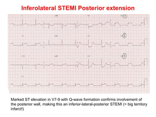 Inferolateral STEMI Posterior extension
Marked ST elevation in V7-9 with Q-wave formation confirms involvement of
the posterior wall, making this an inferior-lateral-posterior STEMI (= big territory
infarct!)
 
