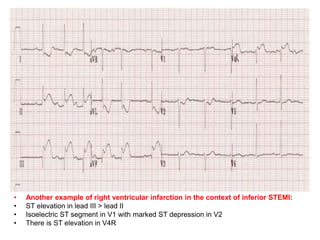 • Another example of right ventricular infarction in the context of inferior STEMI:
• ST elevation in lead III > lead II
• Isoelectric ST segment in V1 with marked ST depression in V2
• There is ST elevation in V4R
 