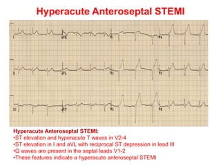 Hyperacute Anteroseptal STEMI
Hyperacute Anteroseptal STEMI:
•ST elevation and hyperacute T waves in V2-4
•ST elevation in I and aVL with reciprocal ST depression in lead III
•Q waves are present in the septal leads V1-2
•These features indicate a hyperacute anteroseptal STEMI
 