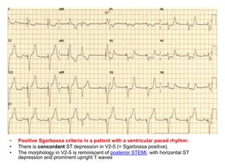 • Positive Sgarbossa criteria in a patient with a ventricular paced rhythm:
• There is concordant ST depression in V2-5 (= Sgarbossa positive).
• The morphology in V2-5 is reminiscent of posterior STEMI, with horizontal ST
depression and prominent upright T waves
 