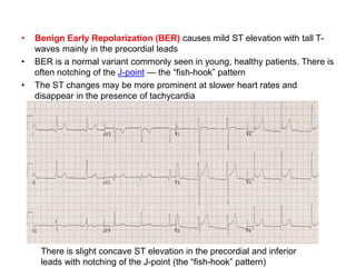 • Benign Early Repolarization (BER) causes mild ST elevation with tall T-
waves mainly in the precordial leads
• BER is a normal variant commonly seen in young, healthy patients. There is
often notching of the J-point — the “fish-hook” pattern
• The ST changes may be more prominent at slower heart rates and
disappear in the presence of tachycardia
There is slight concave ST elevation in the precordial and inferior
leads with notching of the J-point (the “fish-hook” pattern)
 