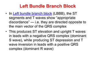 Left Bundle Branch Block
• In Left bundle branch block (LBBB), the ST
segments and T waves show “appropriate
discordance” — i.e. they are directed opposite to
the main vector of the QRS complex
• This produces ST elevation and upright T waves
in leads with a negative QRS complex (dominant
S wave), while producing ST depression and T
wave inversion in leads with a positive QRS
complex (dominant R wave)
 