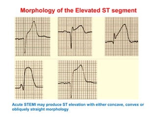 Morphology of the Elevated ST segment
Acute STEMI may produce ST elevation with either concave, convex or
obliquely straight morphology
 