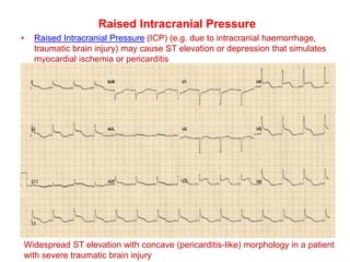 Raised Intracranial Pressure
• Raised Intracranial Pressure (ICP) (e.g. due to intracranial haemorrhage,
traumatic brain injury) may cause ST elevation or depression that simulates
myocardial ischemia or pericarditis
Widespread ST elevation with concave (pericarditis-like) morphology in a patient
with severe traumatic brain injury
 