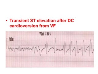 • Transient ST elevation after DC
cardioversion from VF
 