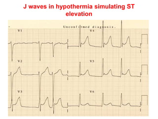 J waves in hypothermia simulating ST
elevation
 
