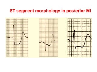 ST segment morphology in posterior MI
 