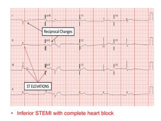 • Inferior STEMI with complete heart block
 